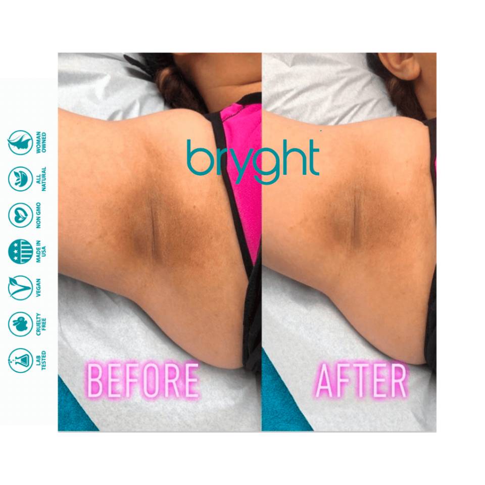 Underarm bleaching; symptoms, causes & treatments