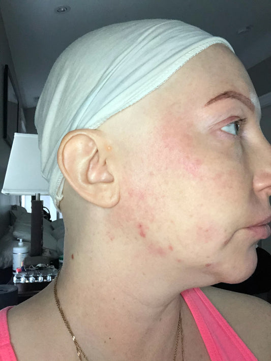 Medical Induced Menopause