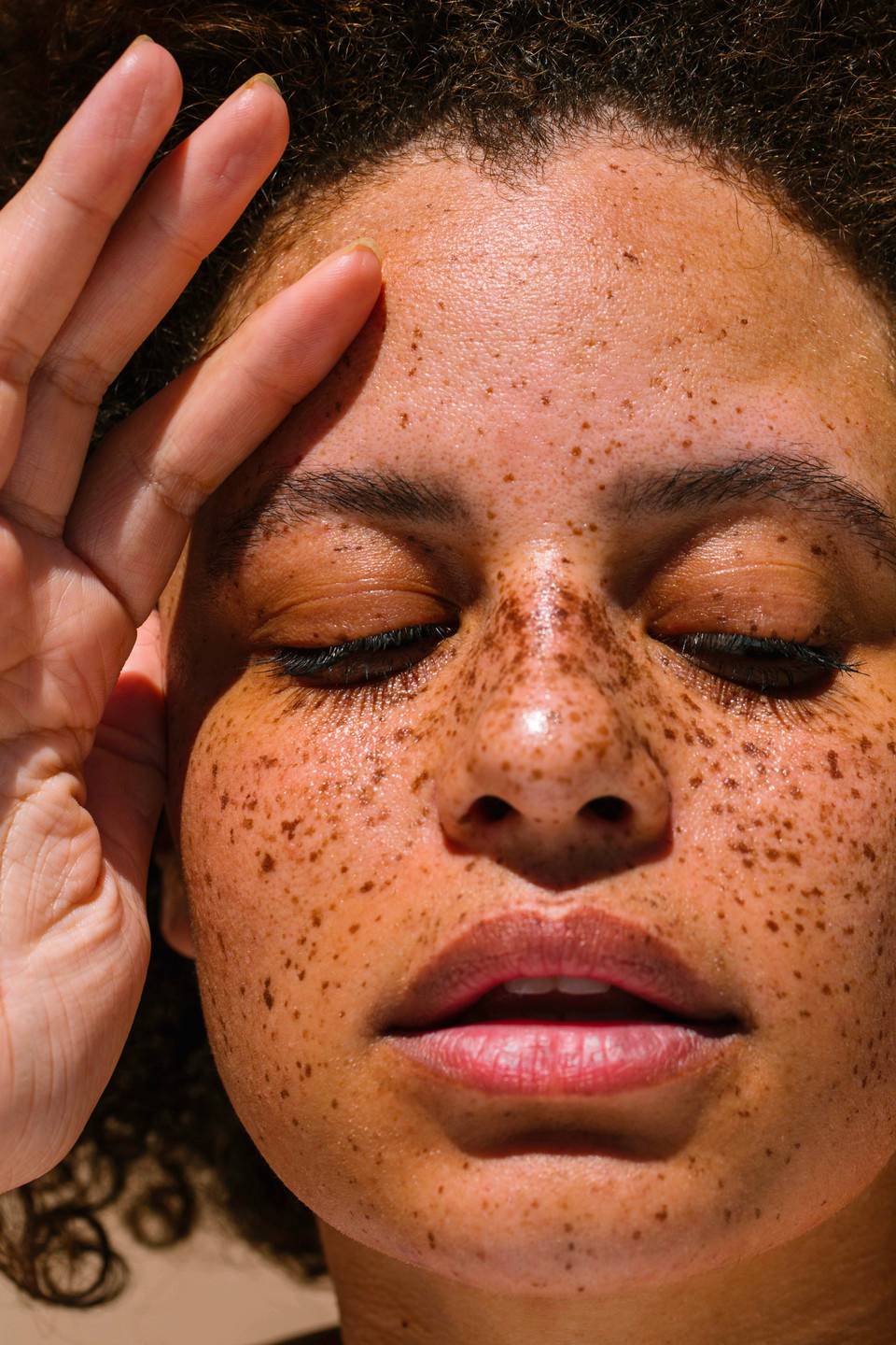 What is hyperpigmentation?